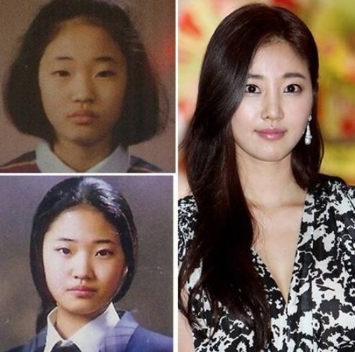 Jang Nara Plastic Surgery